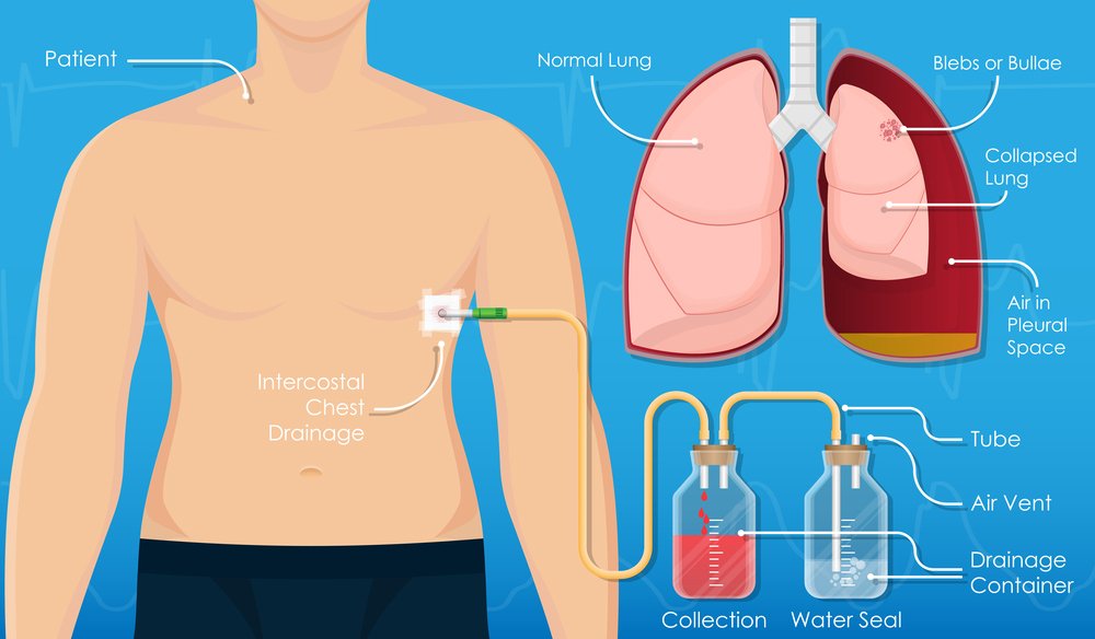 Chest Tap and Tube Drainage